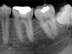 Rentgen dijagnostika zuba